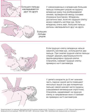 Как делать массаж сердца