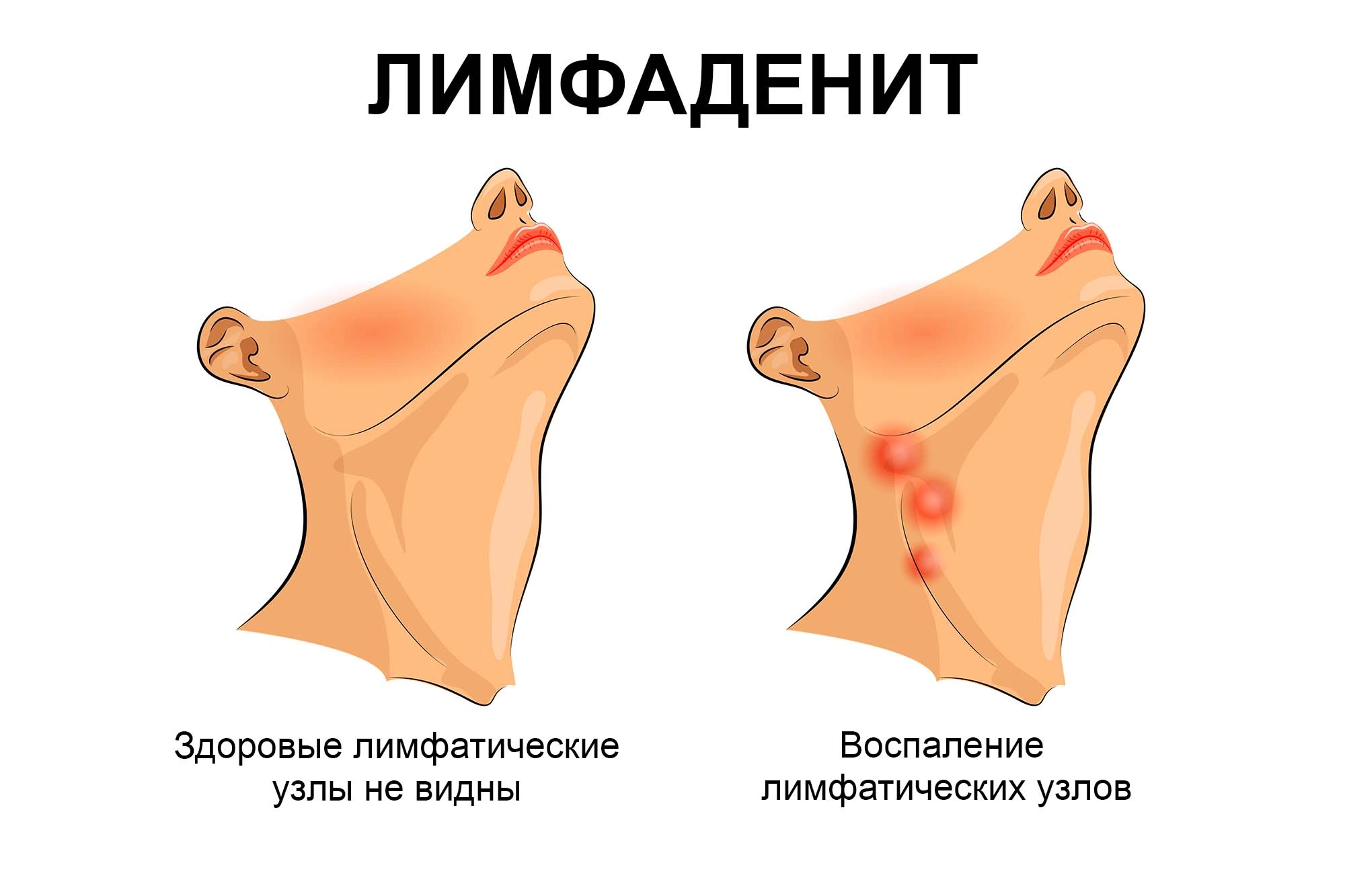 Как снять воспаление лимфоузлов на шее быстро