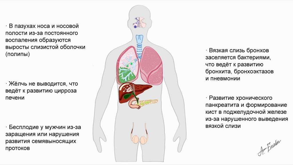 Лечение муковисцидоза