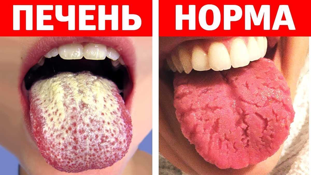 Обожгла язык что делать