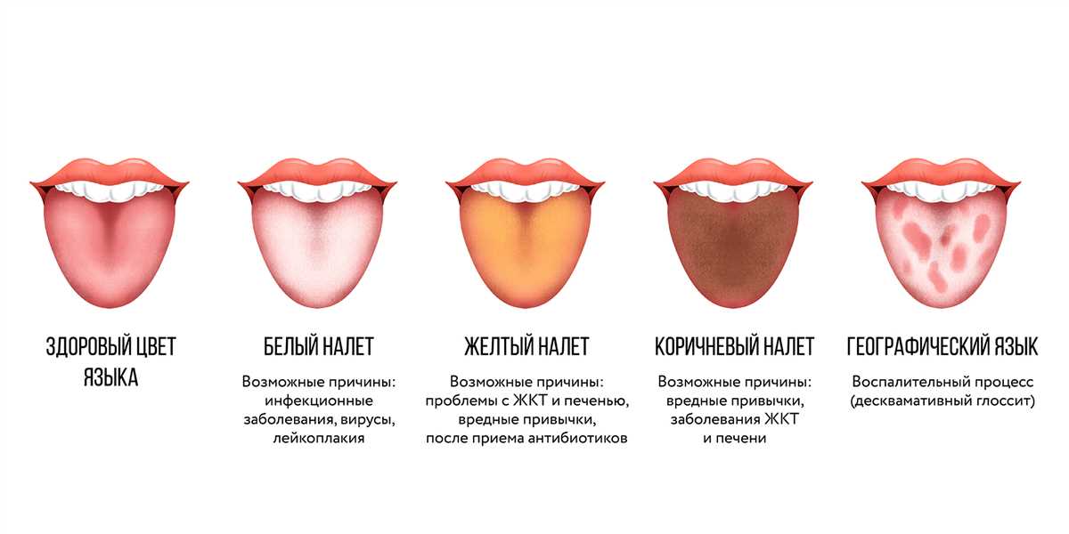 Причины белого налета на языке и способы его устранения