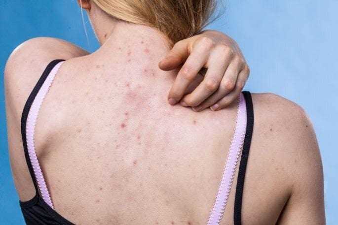 Повышенное выделение кожного сала и спинные прыщи: почему прыщики на спине