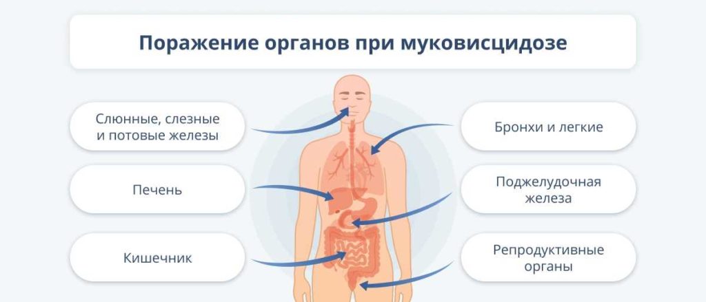 Муковисцидоз что это за болезнь симптомы и лечение